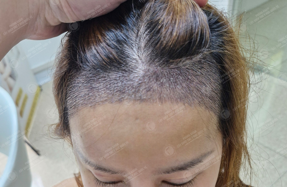 Cù Lệ Quyên - Cấy tóc đường chữ M 5