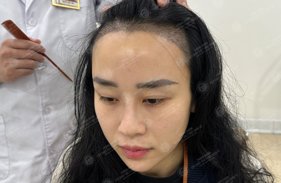 Nguyễn Thanh Hoa - Cấy tóc đường chữ M 5