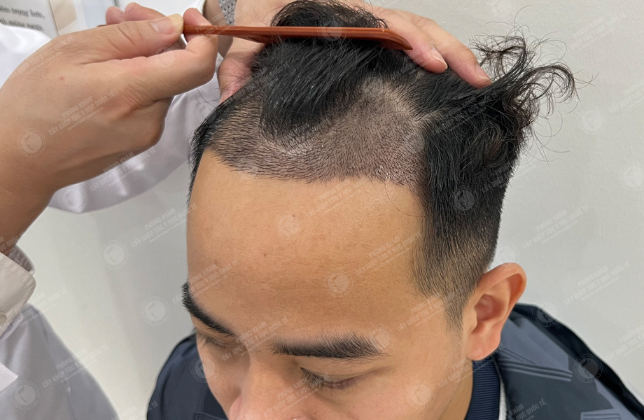 Lý Tùng Thanh - Cấy tóc đường chữ M 5