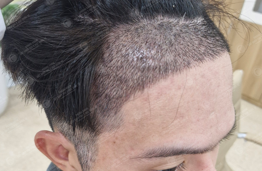 Nguyễn Hoàng Phi - Cấy tóc đường chữ M 5