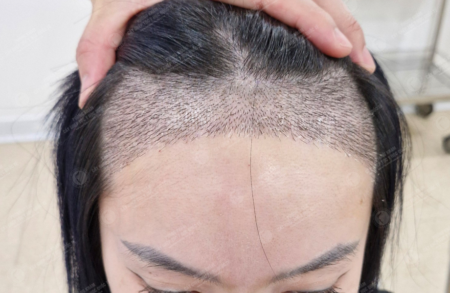 Phạm Thu Huyền - Cấy tóc đường chữ M 5