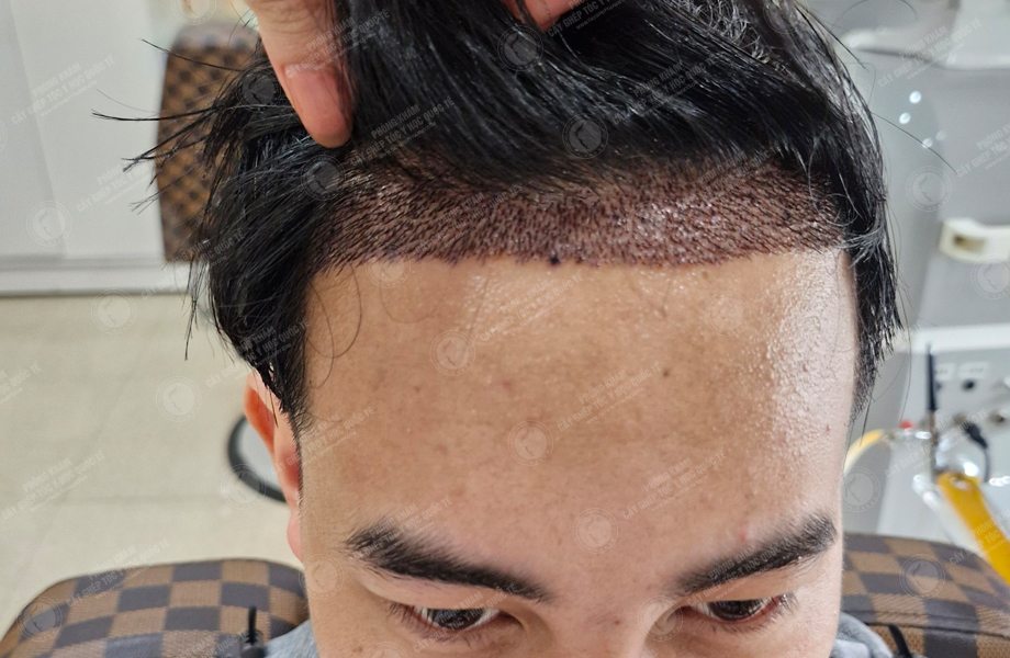 Lã Duy Thanh - Cấy tóc đường chữ M 5