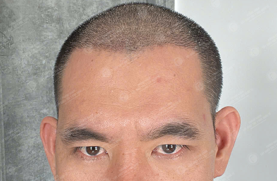 Dương Văn Tiến - Cấy tóc đường chữ M 5