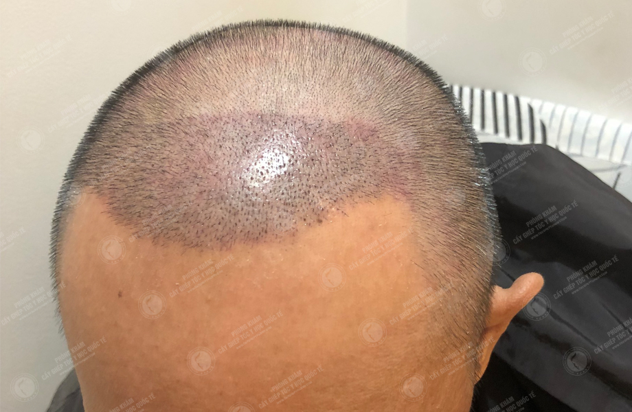 Nguyễn Hữu Huân - Cấy tóc đường chữ M 6