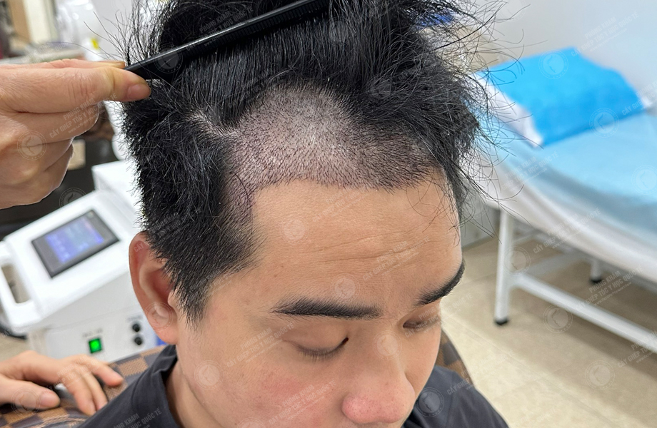 Vi Văn Tam - Cấy tóc đường chữ M 6