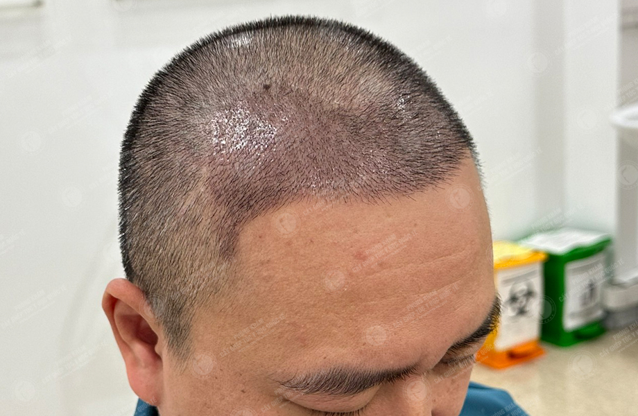 Trần Việt Hoàng - Cấy tóc đường chữ M 6