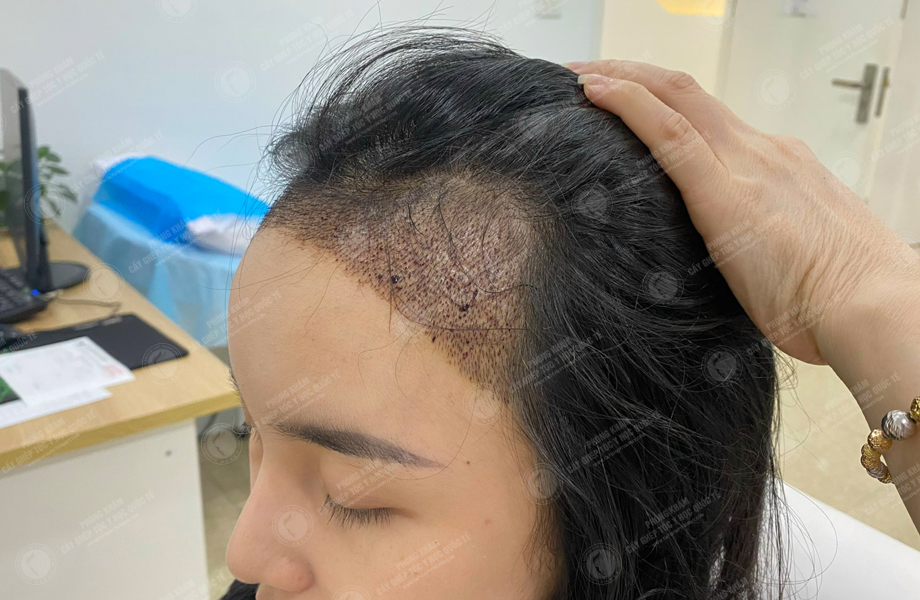 Nguyễn Hoàng Phương - Cấy tóc đường chữ M 6