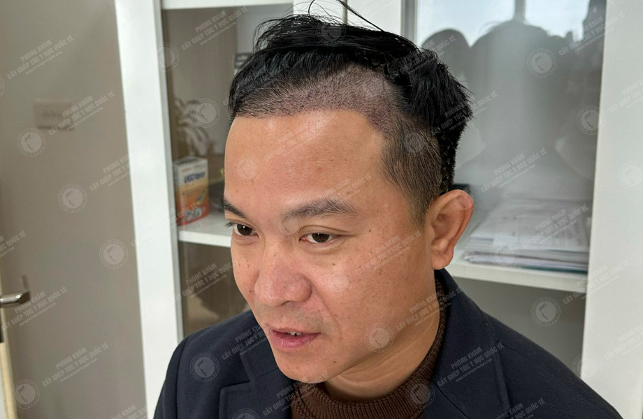 Nguyễn Khoa Tường - Cấy tóc đường chữ M 6