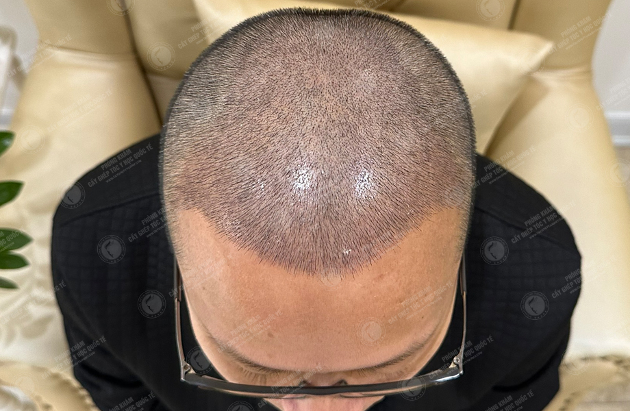 Nguyễn Chí Linh - Cấy tóc đường chữ M 6