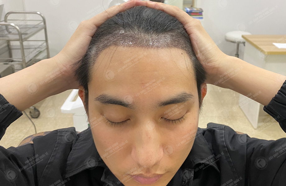 Nguyễn Sỹ Long - Cấy tóc đường chữ M 6