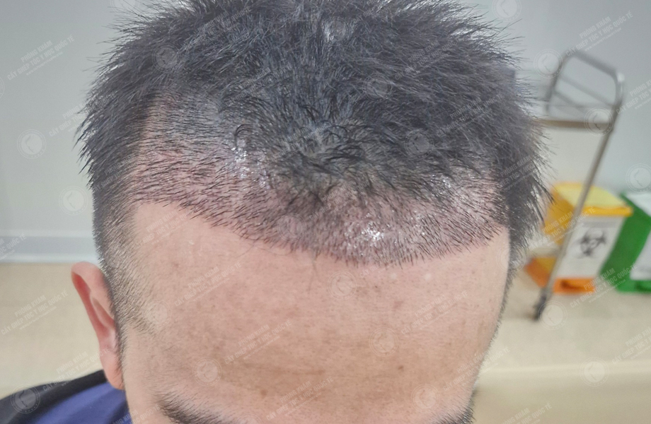 Trần Trung Sơn - Cấy tóc đường chữ M 6