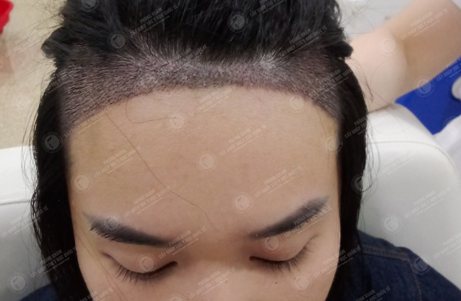 Đinh Thu Hương - Cấy tóc đường chữ M 6