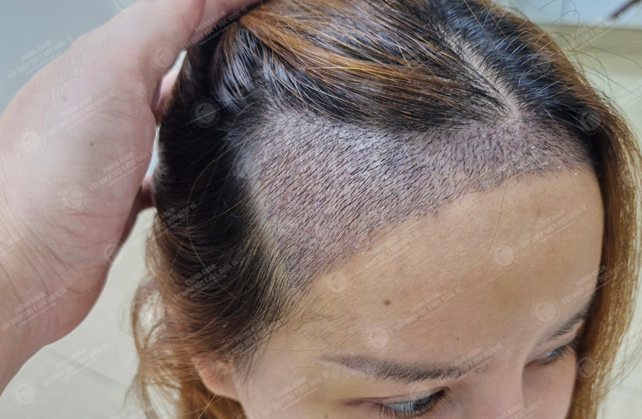 Cù Lệ Quyên - Cấy tóc đường chữ M 6