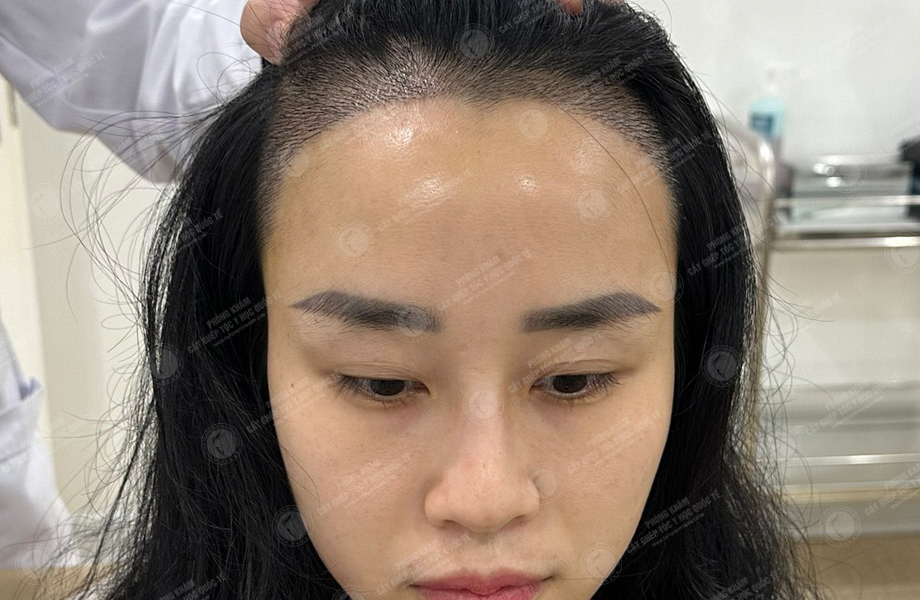 Nguyễn Thanh Hoa - Cấy tóc đường chữ M 6