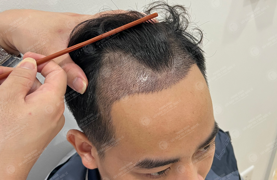 Lý Tùng Thanh - Cấy tóc đường chữ M 6