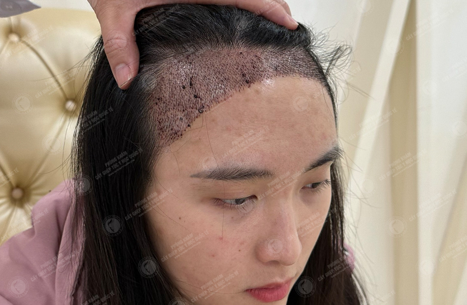 Dư Thu Hoài - Cấy tóc đường chữ M 6