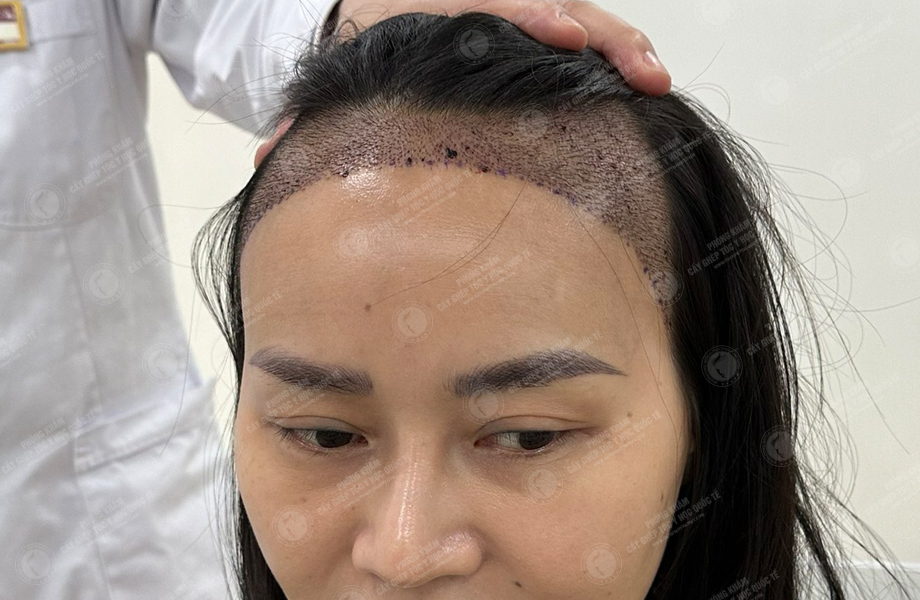 Đỗ Thị Thu Trang - Cấy tóc đường chữ M 6