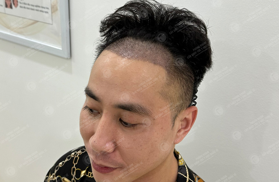 Hoàng Anh Tài - Cấy tóc đường chữ M 6