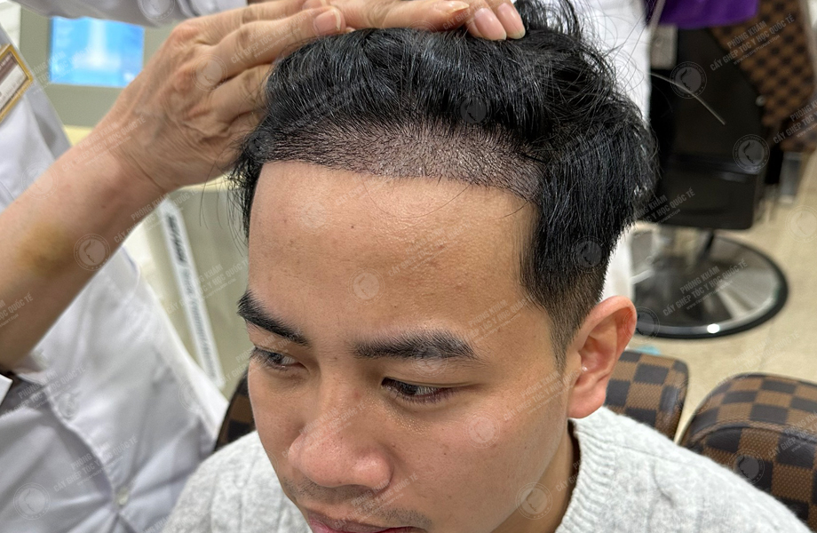 Lã Duy Thanh - Cấy tóc đường chữ M 6