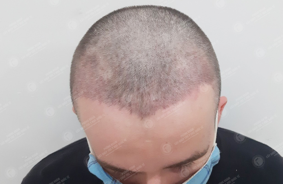 Leo Pary - Cấy tóc đường chữ M 6