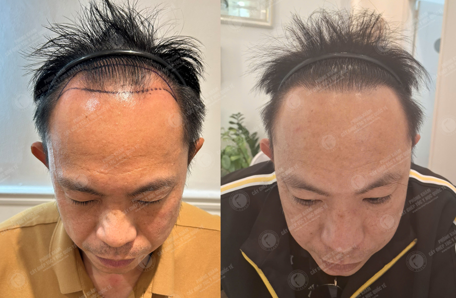  Nguyễn Hữu Huân - Cấy tóc đường chữ M 1