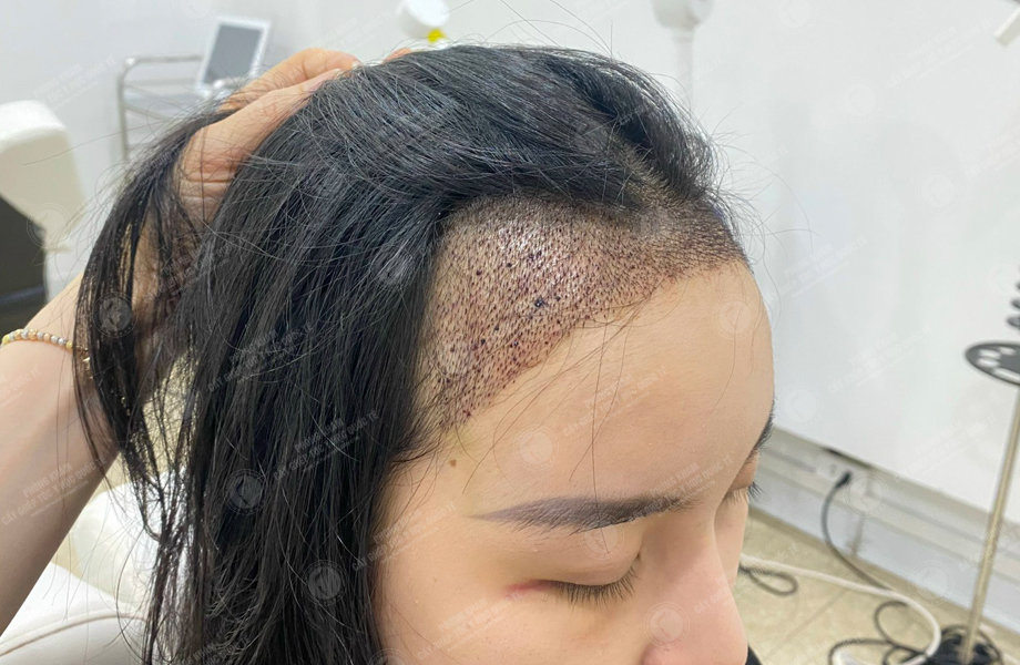 Nguyễn Hoàng Phương - Cấy tóc đường chữ M 7