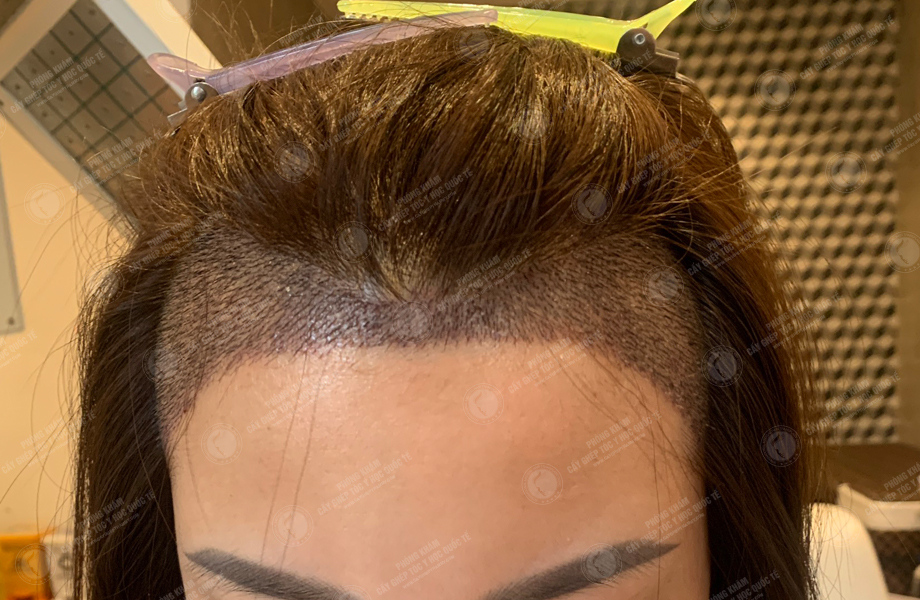 Nguyễn Thi Vân - Cấy tóc đường chữ M 6