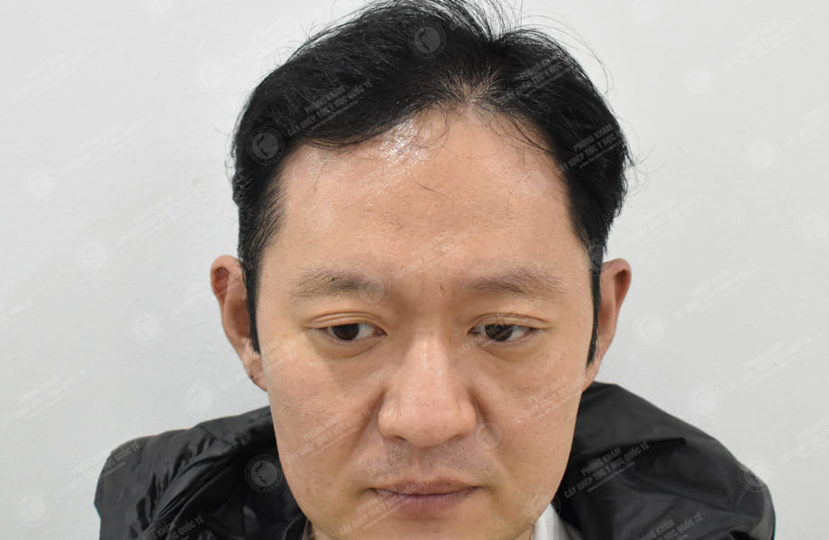 Han Seongmin - Cấy tóc đường chữ M 9