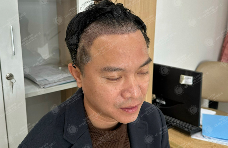 Nguyễn Khoa Tường - Cấy tóc đường chữ M 7