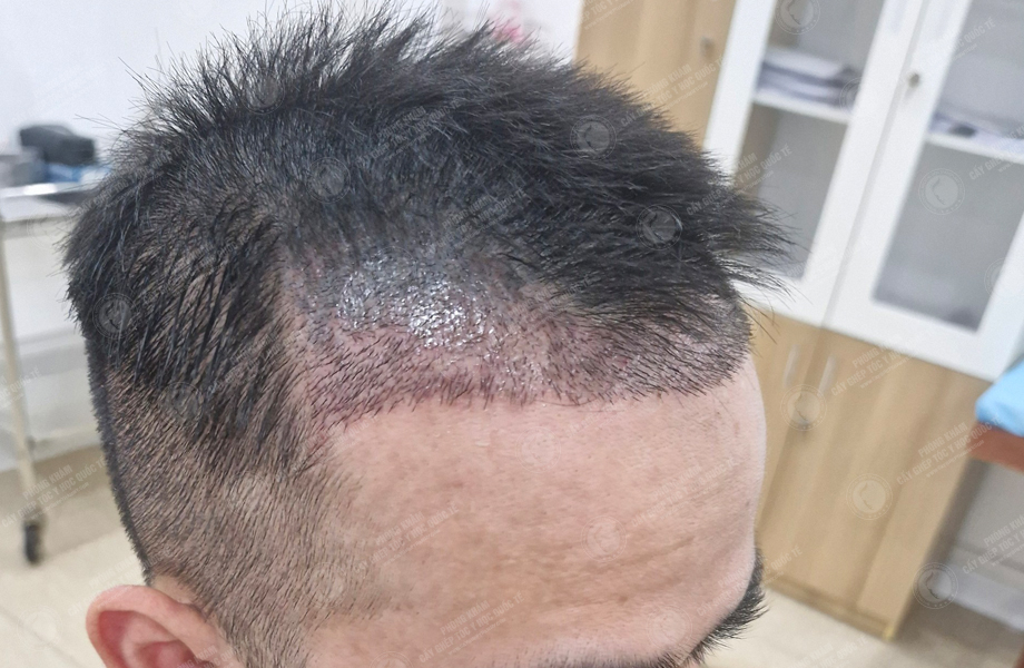 Trần Trung Sơn - Cấy tóc đường chữ M 7