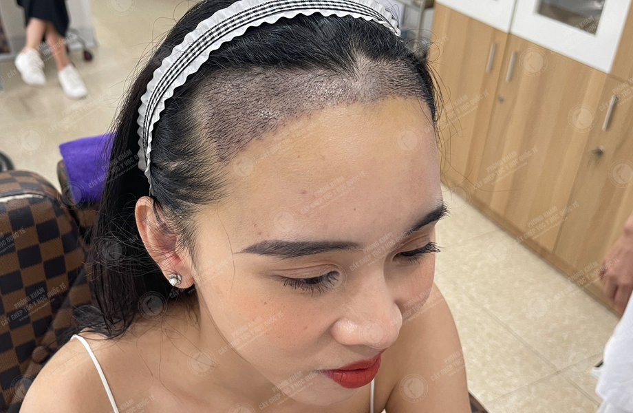 Hoàng Hồng Yến - Cấy tóc đường chữ M 7