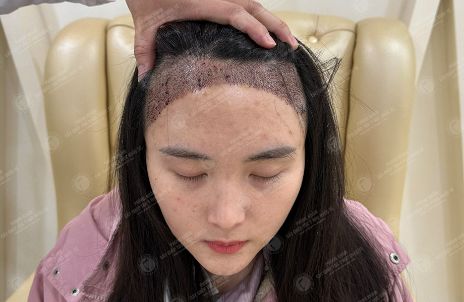 Dư Thu Hoài - Cấy tóc đường chữ M 7