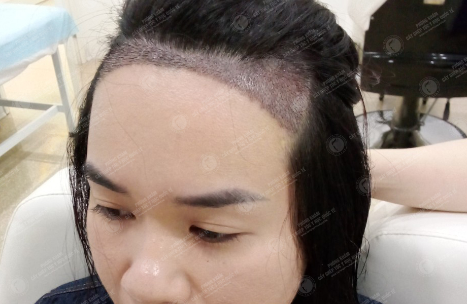 Đinh Thu Hương - Cấy tóc đường chữ M 7
