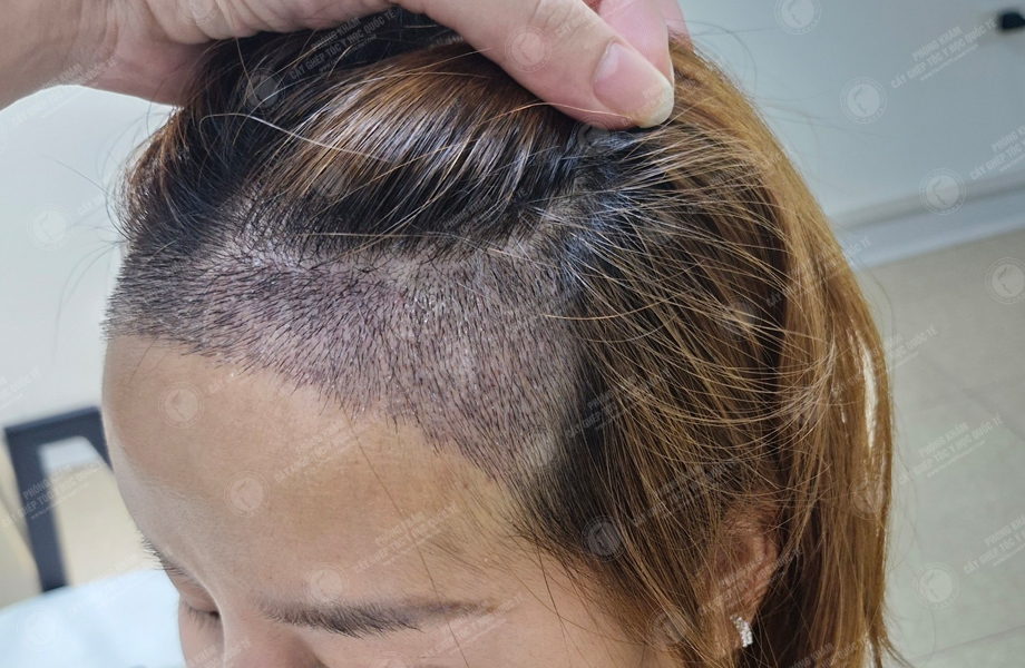 Cù Lệ Quyên - Cấy tóc đường chữ M 7