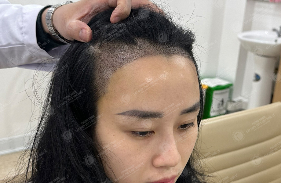 Nguyễn Thanh Hoa - Cấy tóc đường chữ M 7