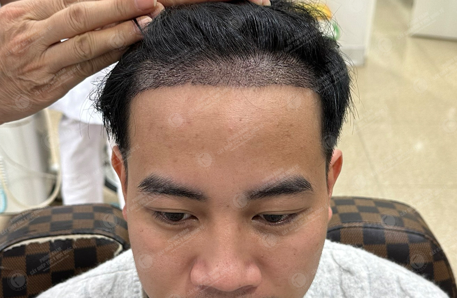 Lã Duy Thanh - Cấy tóc đường chữ M 7
