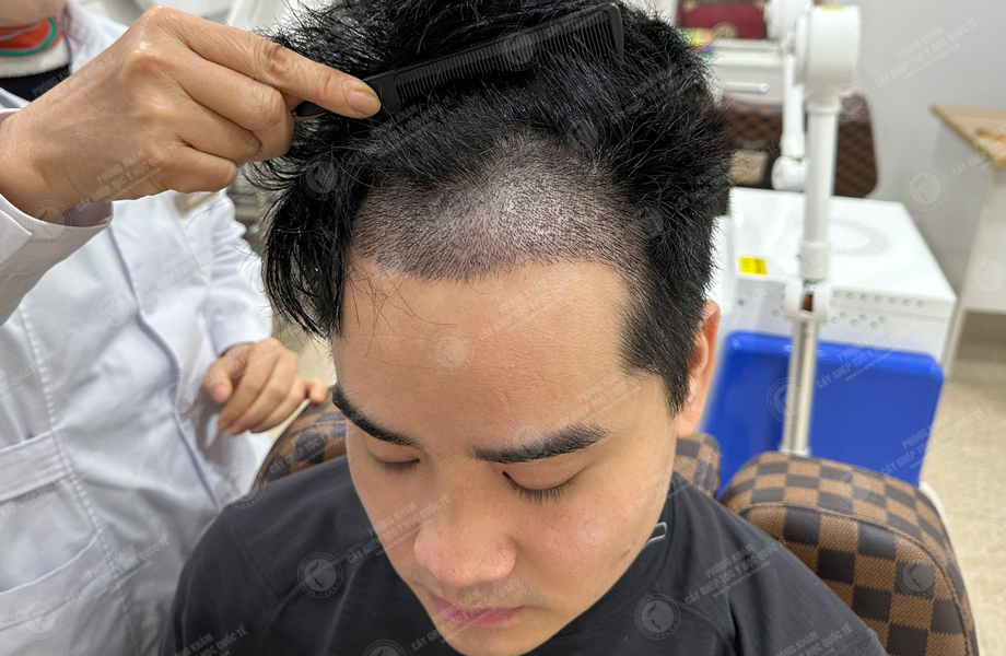 Vi Văn Tam - Cấy tóc đường chữ M 7