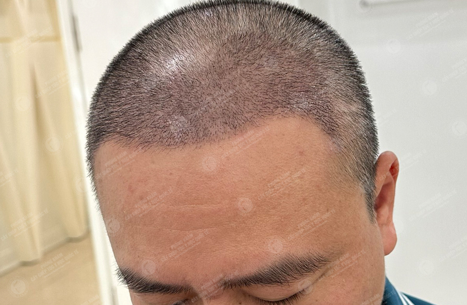 Trần Việt Hoàng - Cấy tóc đường chữ M 7