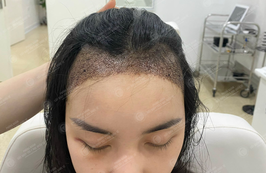 Nguyễn Hoàng Phương - Cấy tóc đường chữ M 8