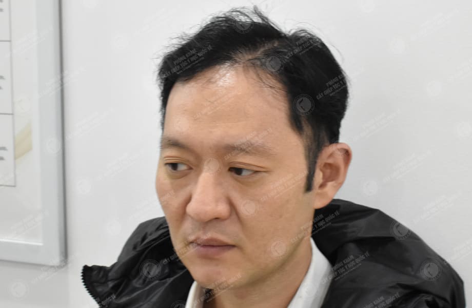 Han Seongmin - Cấy tóc đường chữ M 8
