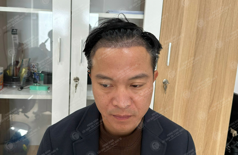 Nguyễn Khoa Tường - Cấy tóc đường chữ M 8