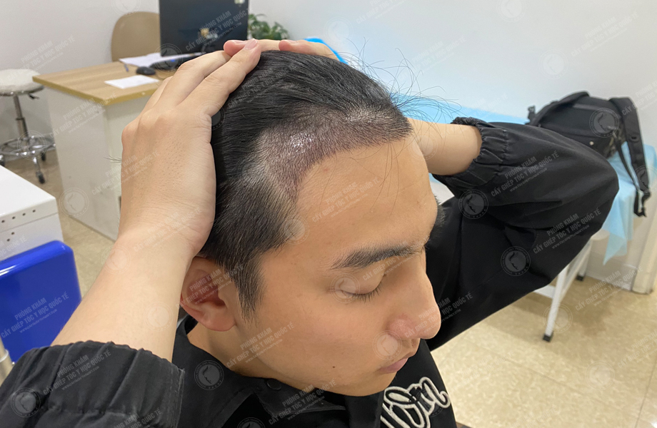 Nguyễn Sỹ Long - Cấy tóc đường chữ M 8