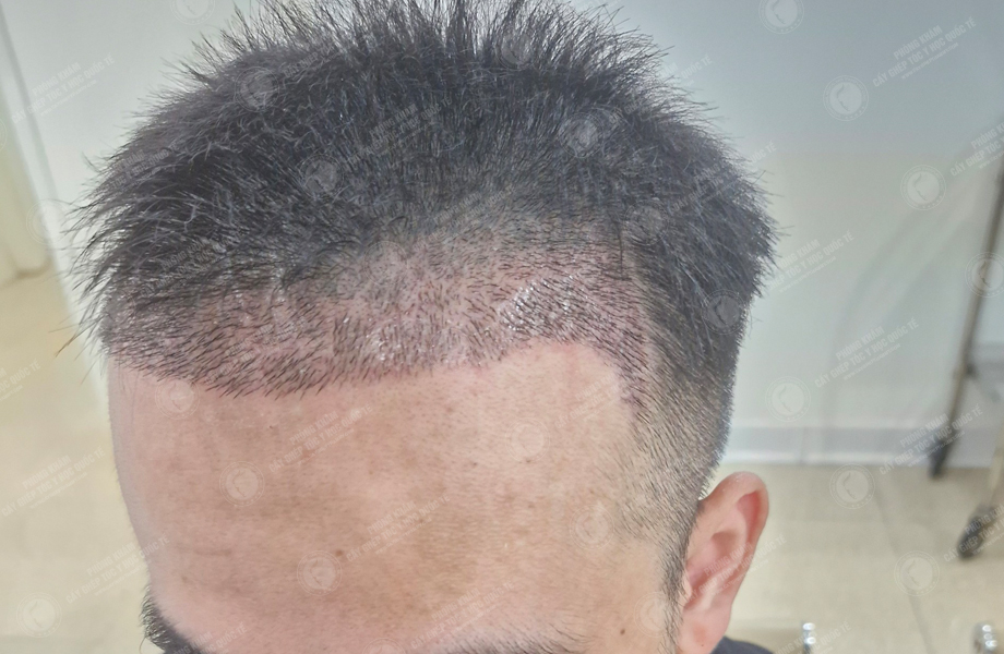 Trần Trung Sơn - Cấy tóc đường chữ M 8