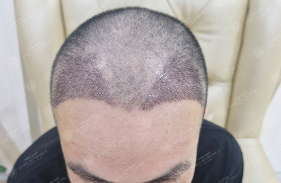 Đỗ Tùng Sang - Cấy tóc đường chữ M 8