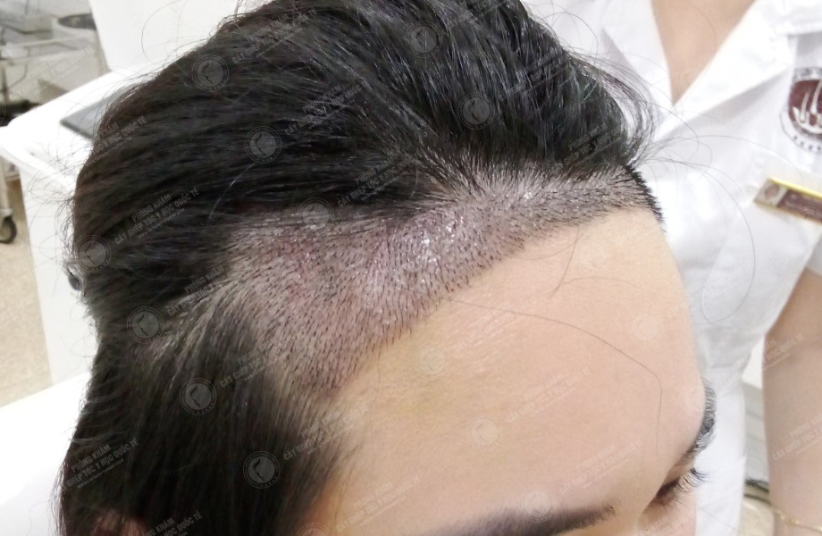 Đinh Thu Hương - Cấy tóc đường chữ M 8