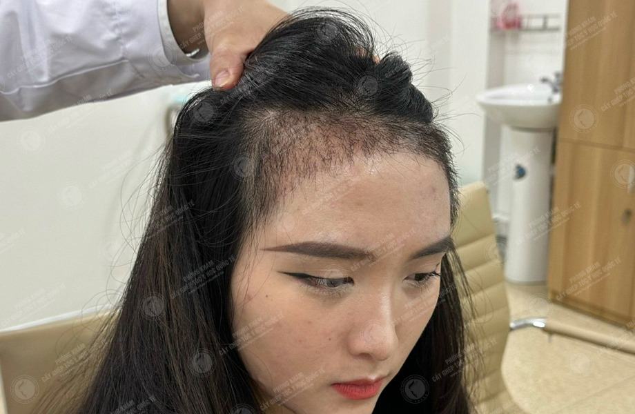 Dư Thu Hoài - Cấy tóc đường chữ M 8