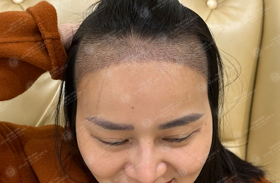Đỗ Thị Thu Trang - Cấy tóc đường chữ M 8