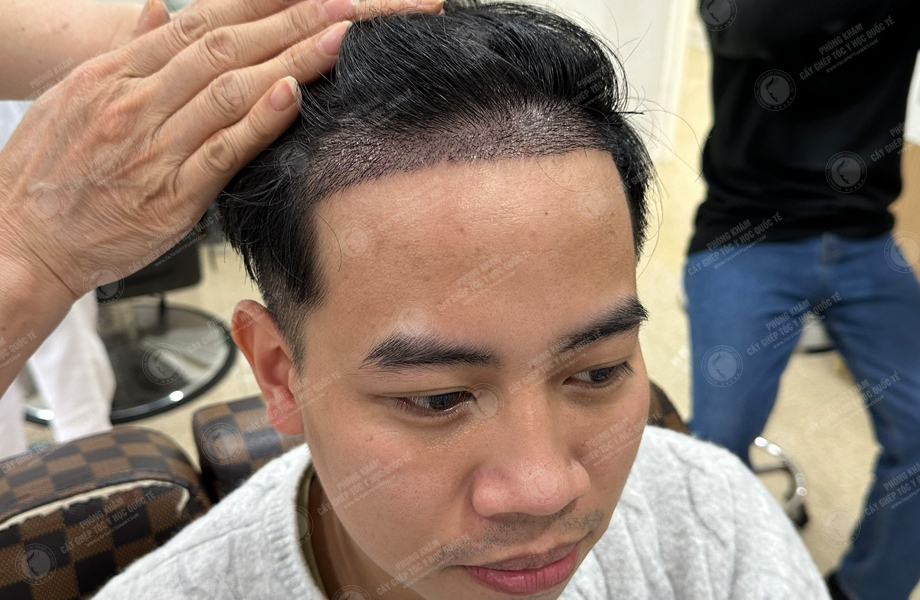 Lã Duy Thanh - Cấy tóc đường chữ M 8