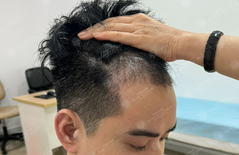 Vi Văn Tam - Cấy tóc đường chữ M 8