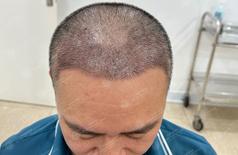 Trần Việt Hoàng - Cấy tóc đường chữ M 8